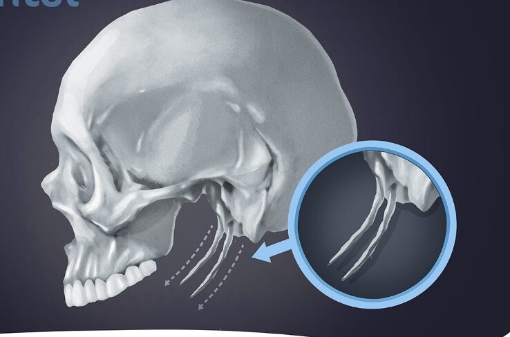 Eagle’s syndrome: A Complete Guide to This Rare Condition